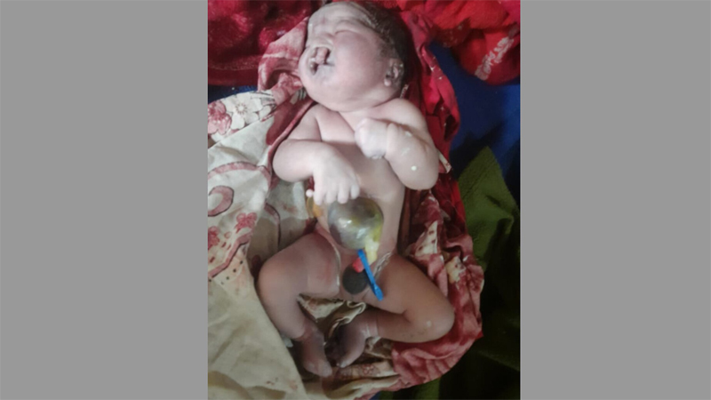 বালাগঞ্জে হাতে-পায়ে ২৪টি আঙুলসহ জন্ম নবজাতকের