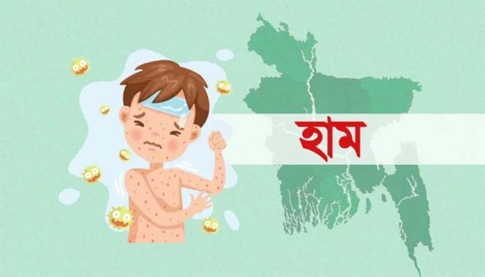 হাম ও উপসর্গে আরও ৫ শিশুর মৃত্যু: স্বাস্থ্য অধিদপ্তর