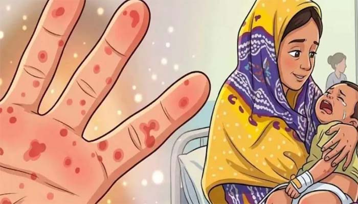 হামের উপসর্গে আরও ৭ জনের মৃত্যু